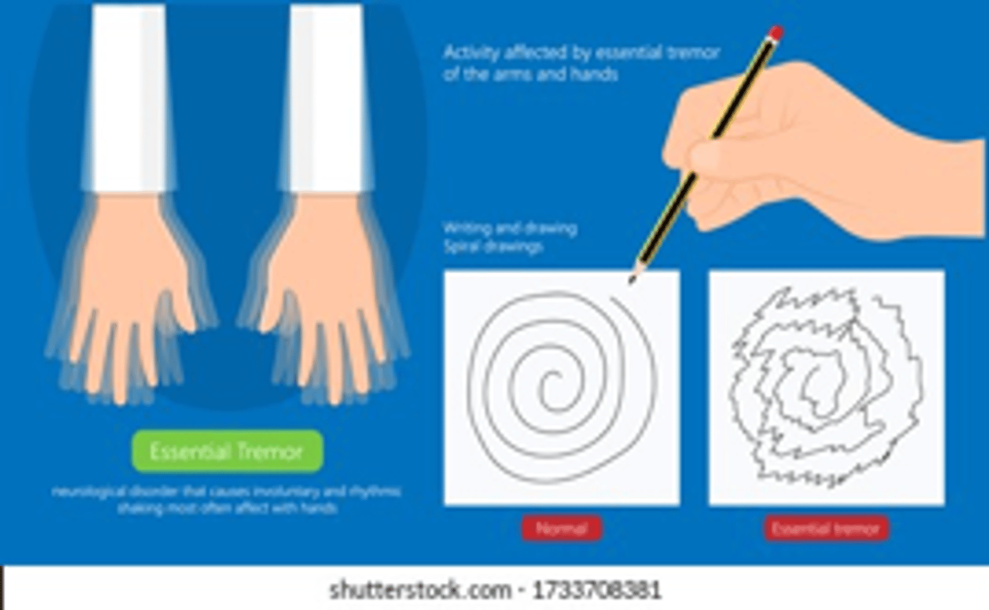 <p>Most common movement disorder that usually presents as a b/l postural tremor of the hands followed by a tremor w/ action/movement (can also affect head, voice, &amp; other areas); often seen in young people w/ a family hx</p>