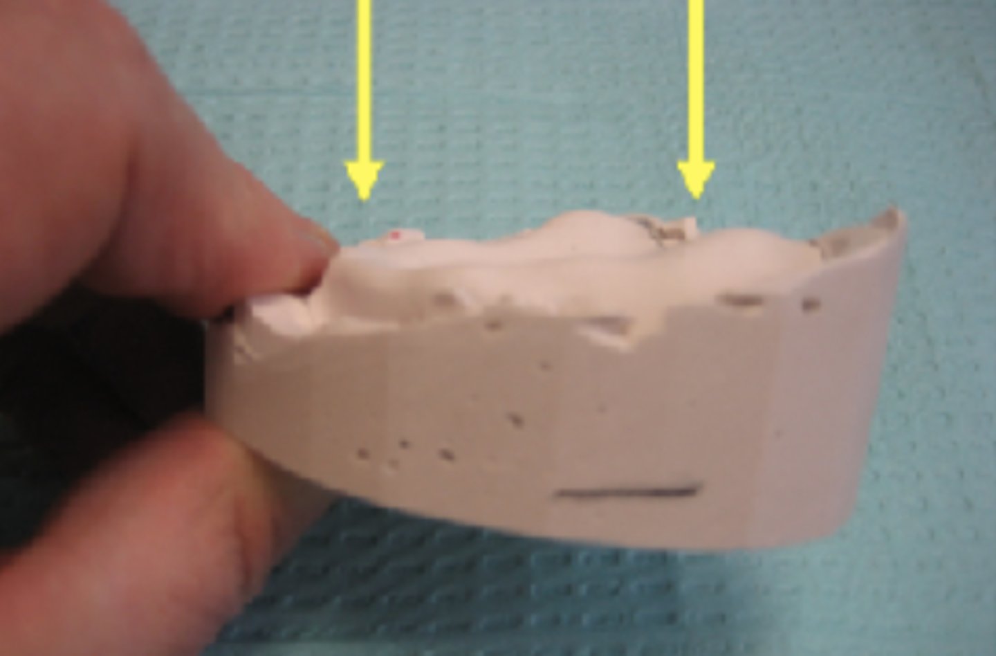 <p>Define the following:</p><p>_______ is from the midline crest of the residual ridge, anteriorly, to the crests of the left and right tuberosities, posteriorly.</p>