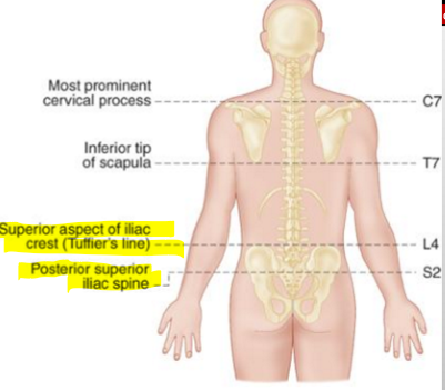 <p>S2 &amp; and its by the ILIAC SPINE</p>