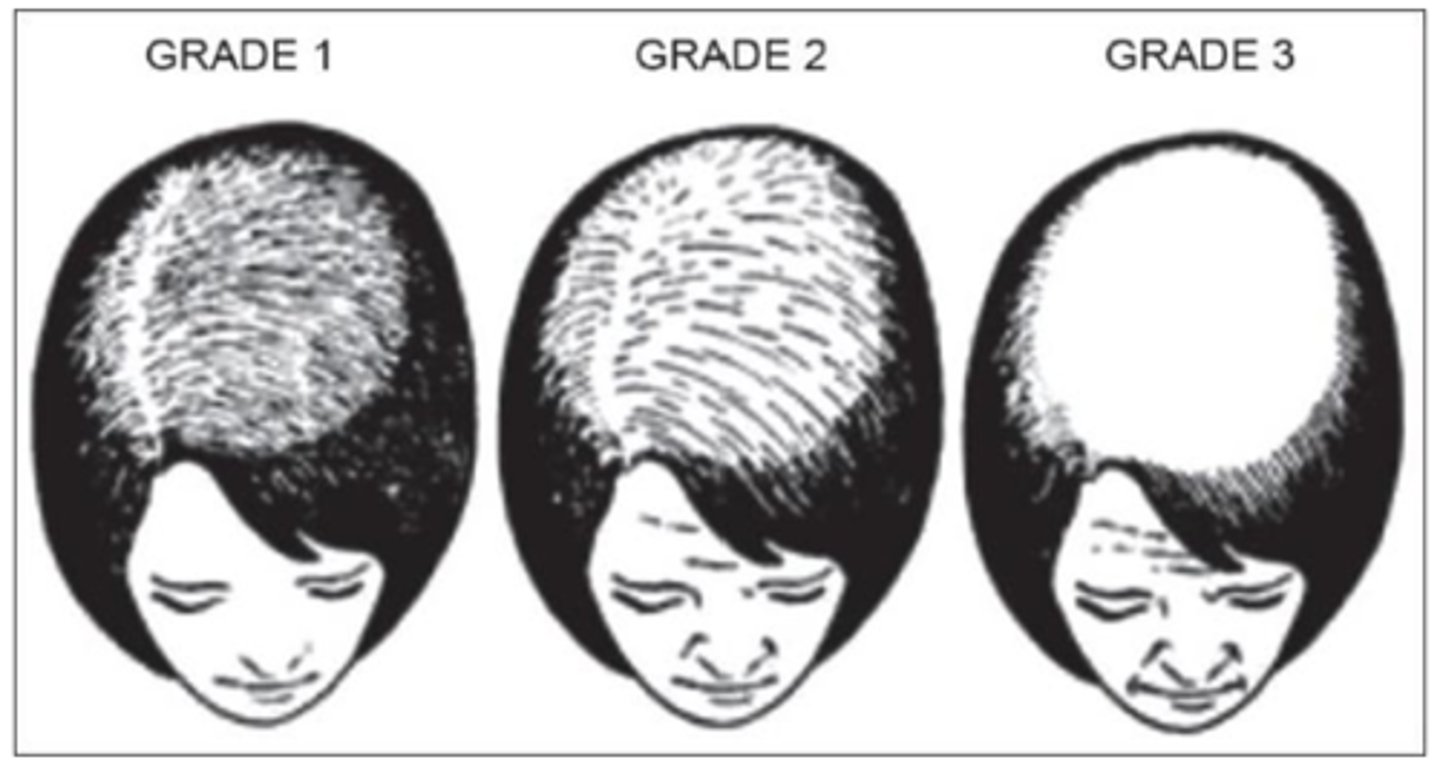 <p>Stages of female pattern hair loss</p>
