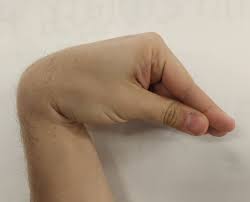 <p>Sign of hypocalcemia when a blood pressure cuff is inflated and there is palmar flexion.</p>