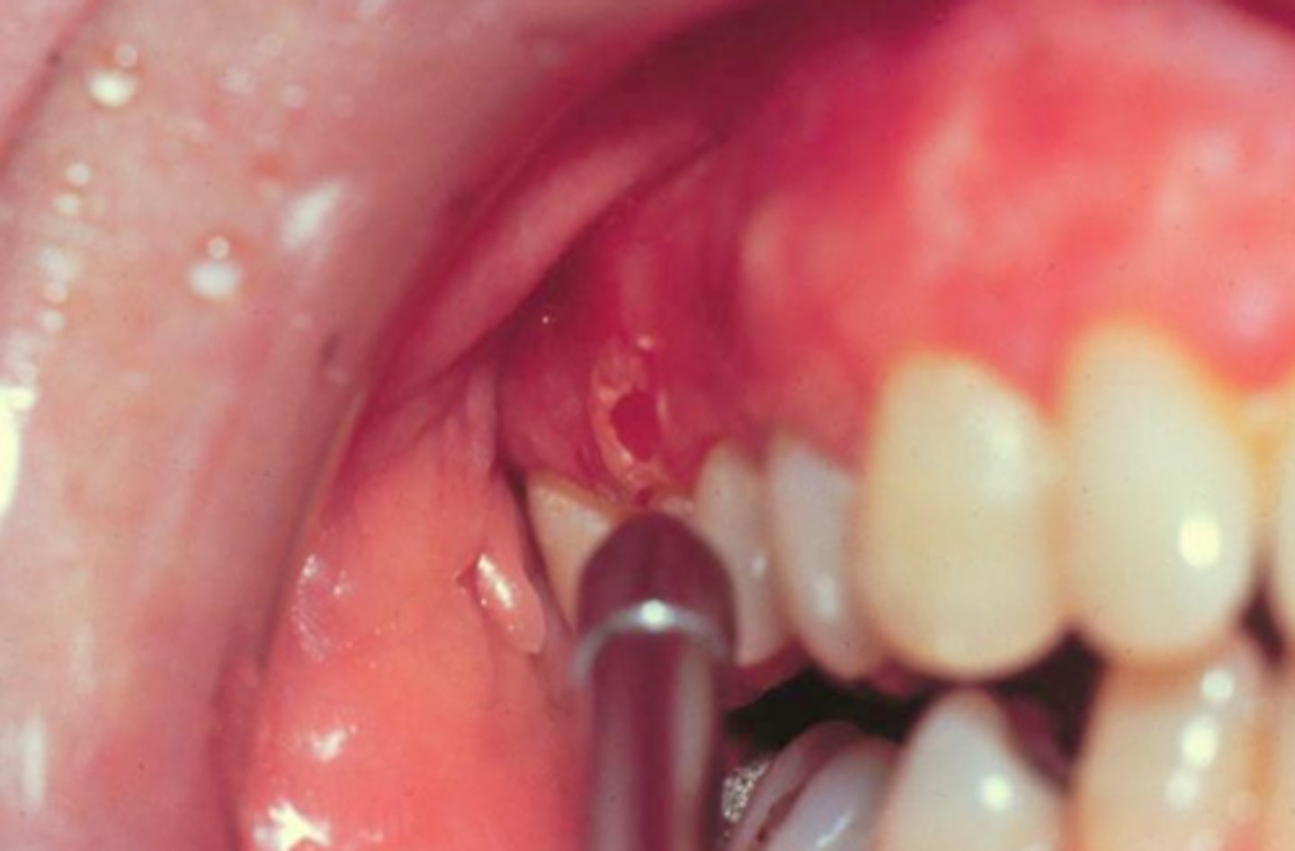 <p>nikolsky sign</p>