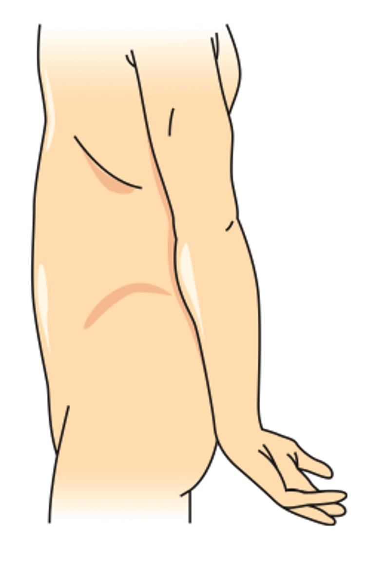 <p>Aka WAITER'S TIP</p><p>Injury: upper trunk, roots C5-C6</p><p>Causes:</p><p>infants - lateral traction on neck during delivery</p><p>adults - trauma</p><p>Muscle Deficit/Functional Deficit:</p><p>1. deltoid, supraspinatus --> abduction (arm hangs at side)</p><p>2. infraspinatus --> lateral rotation (arm medially rotated)</p><p>3. biceps brachii --> flexion, supination (arm extended and pronated)</p><p>Presentation:</p><p>see picture</p>