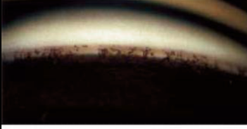 <p>what is the finding shown in this image? </p>