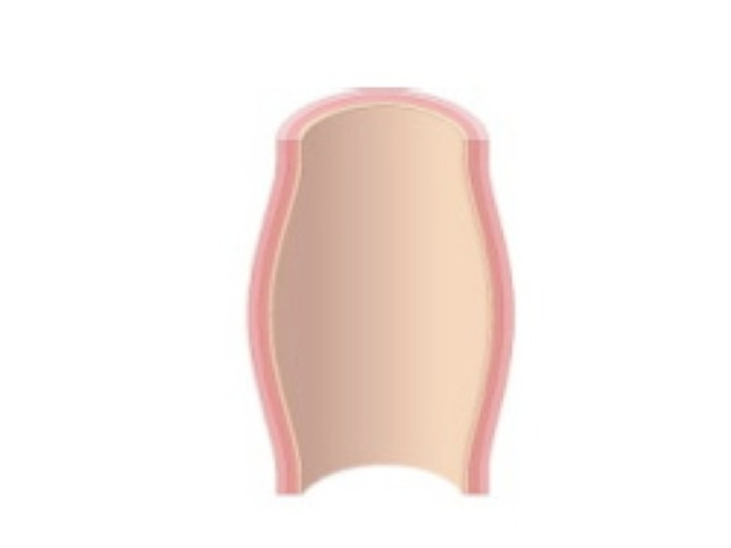 <p>A sac formed by dilation in the artery wall</p>