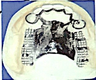 <ul><li><p>description : bonne sustentation </p></li><li><p>Indications : classe I, II, IV de moyenne et grande étendue, si crête résorbée </p></li></ul><p></p>