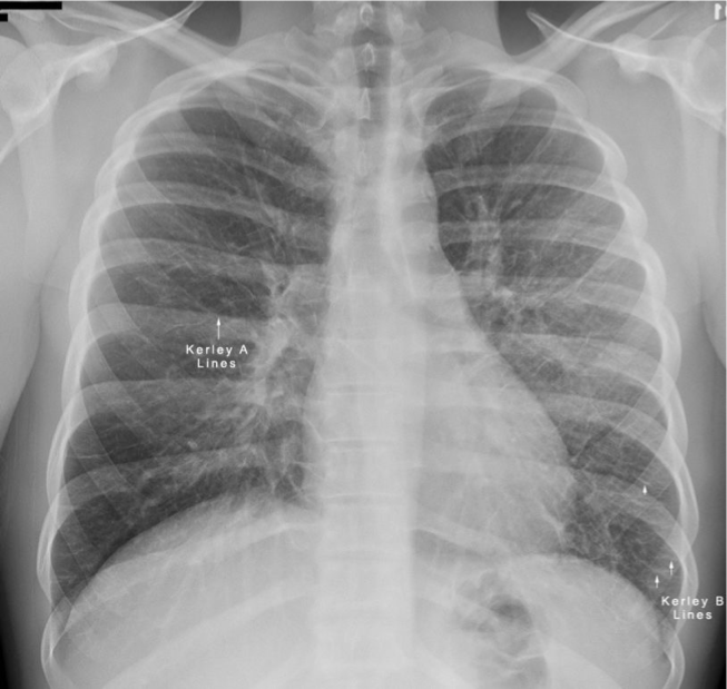 <p>Differentiate between Kerley A vs Kerley B lines.</p>