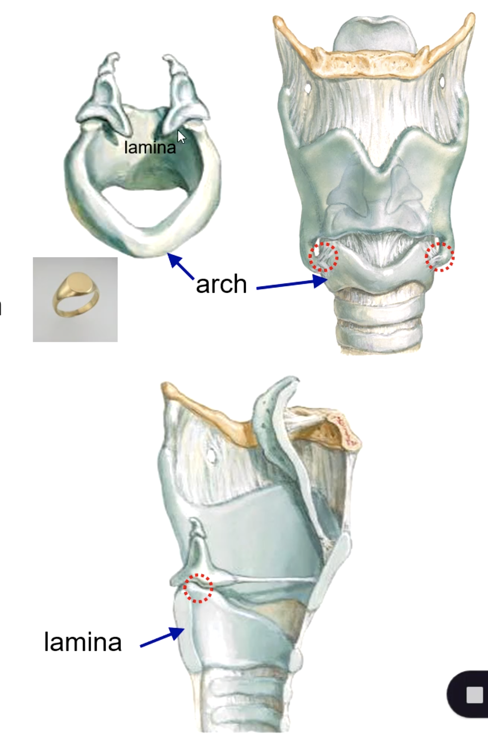 <p>arytenoid cartilage (synovial joint)</p>