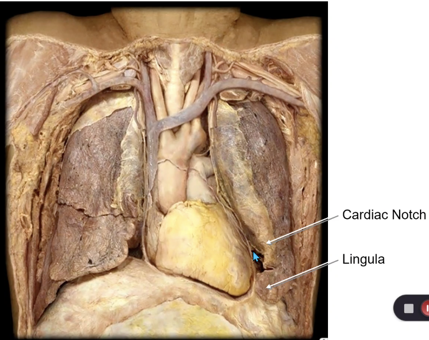 <p>superior lobe of left lung</p>
