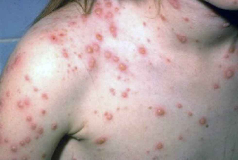 <p>the image is of a child who has the chickenpox. what type of rash does chickenpox present with?</p>