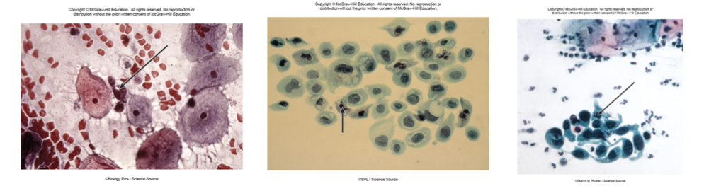 <p>Cancerous cells are odd shapes, with larger nuclei that stain darker when looked at under a microscope</p>