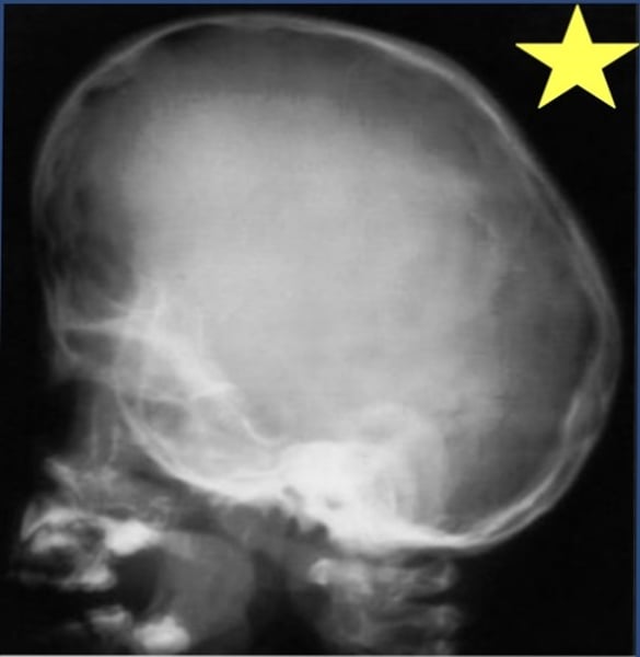 <p>Identify the radiographic abnormality, caused by coronal craniosynostosis.</p>