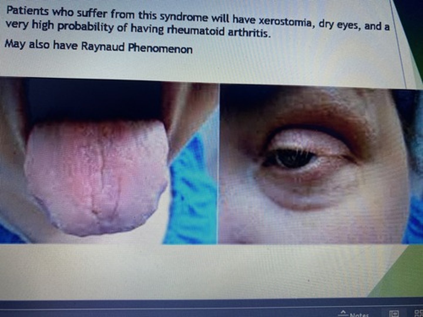 <p>Patients who suffer from this syndrome will have xerostomia, dry eyes, and a very high probability of having rheumatoid arthritis.</p><p>May also have Raynaud Phenomenon.</p>