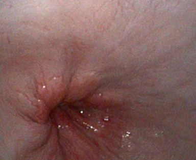 <p>inflammation of the esophagus</p>