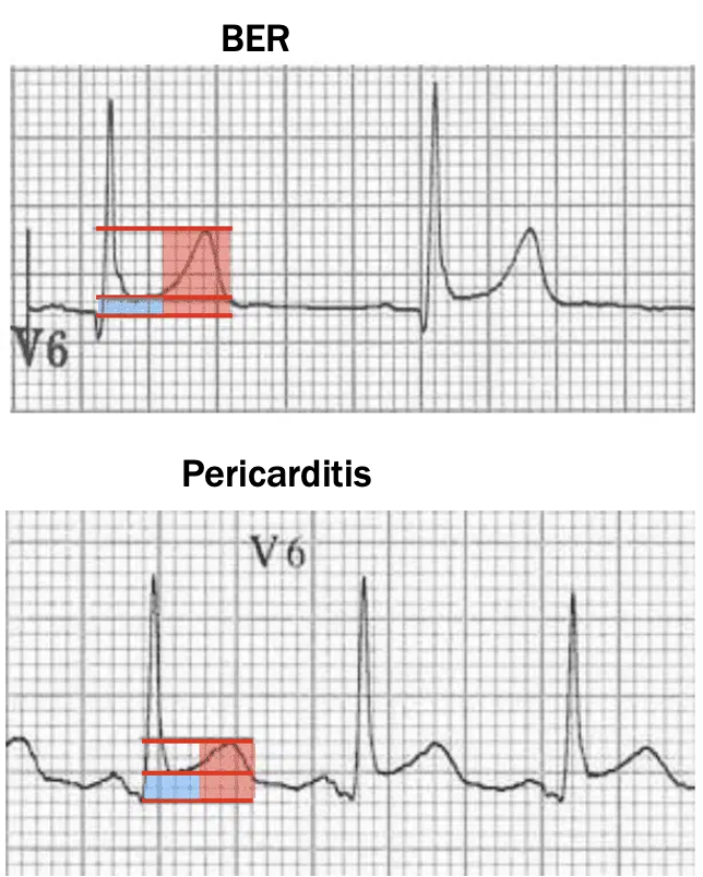 <p>w/ lead V6 </p><p>BER- more T wave than ST elevation; </p><p>pericarditis- more ST elevation than T wave</p>