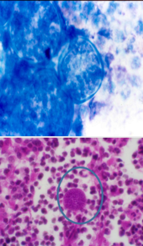 <p>which fungal infection is seen in this slide?</p>