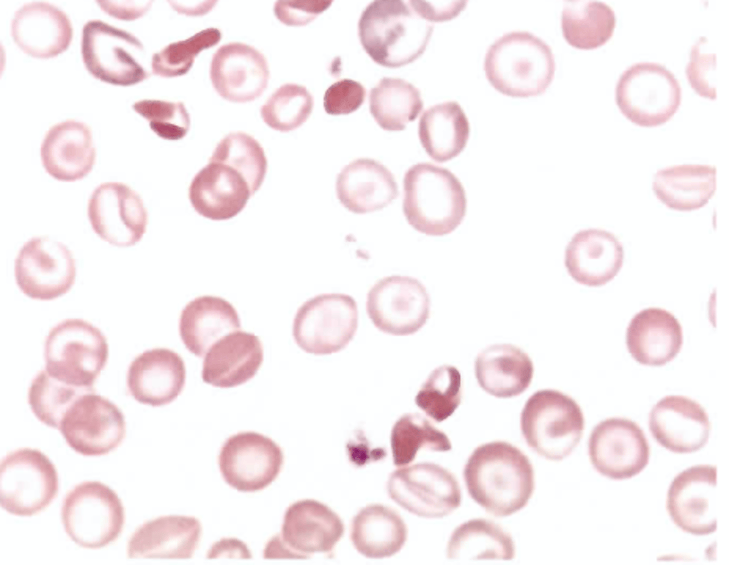 <p>C. Hemoglobin SC disease</p>