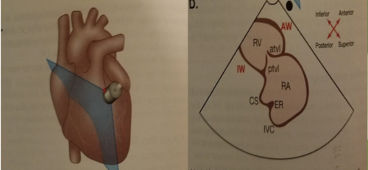 <p>TV- tricuspid valve (leaflets: ATVL &amp; PTVL)</p><p>RV -right ventricle</p><p>MB-moderator band</p><p>RA-right atrium</p><p>CS-coronary sinus</p><p>IVC-inferior vena cava</p><p>ER- eustation ridge</p><p>*Tilt face inferior</p>