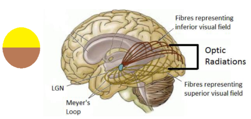 <ul><li><p>Optic radiations - can split them into inferior and superior.</p></li><li><p>Images from superior visual field processed by inferior parts of the retina - adjacent representations.</p></li><li><p>That mapping retained for the rest of the visual system.</p></li><li><p>Inferior optic radiations - processing for superior visual field</p></li><li><p>IOR - come through part of temp lobe</p></li><li><p>SOR - come through part of parietal lobe</p></li><li><p>Both I and S are branches of middle cerebral artery and branches from posterior cerebral artery as they move to more posterior sections.</p></li></ul><p></p>