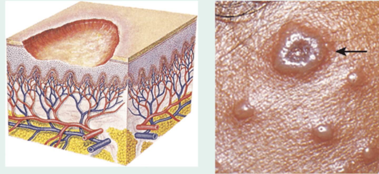 <p>Nonscarring loss of superficial epidermis. Surface is moist but does not bleed.</p>