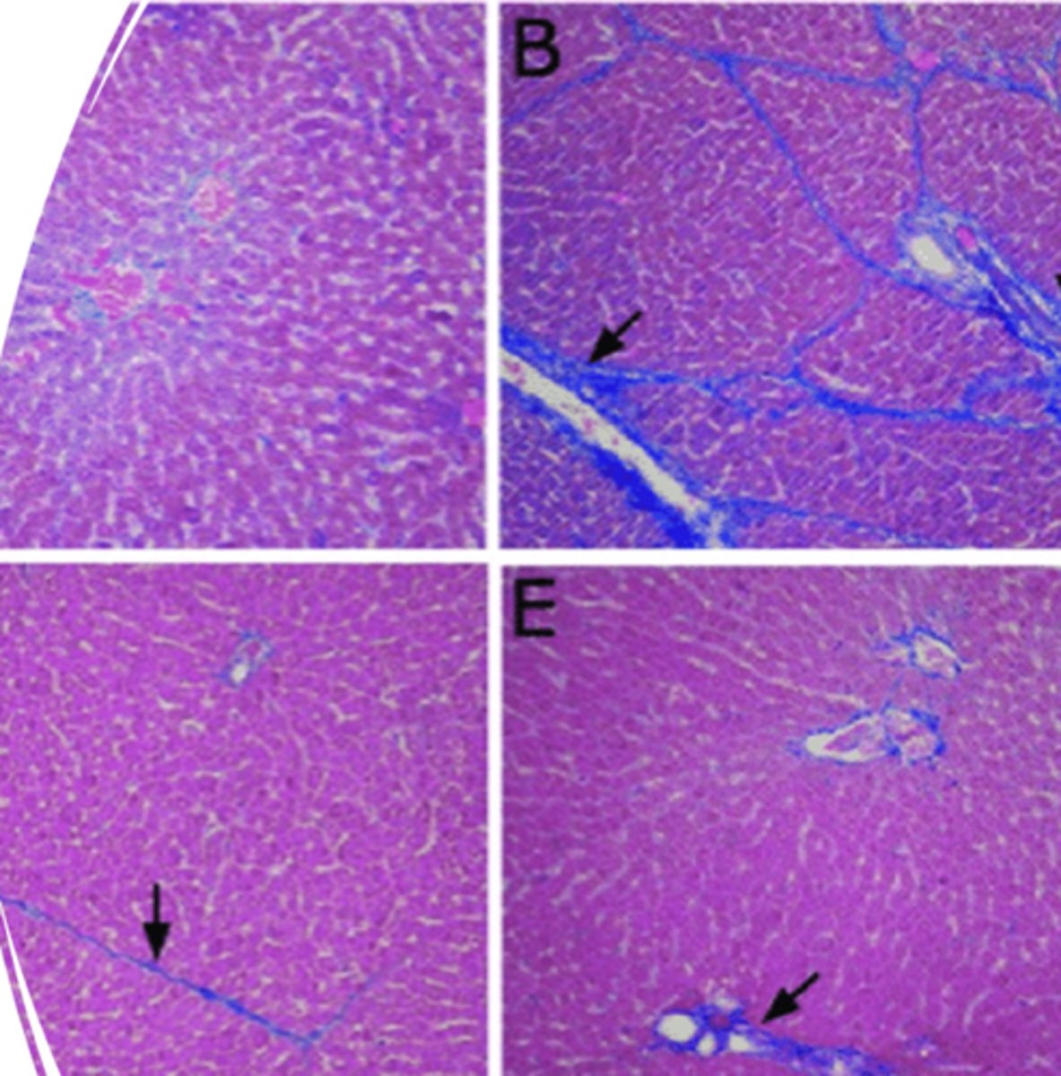 <p>What is indicated in this image that is a result of chronic liver injury?</p>