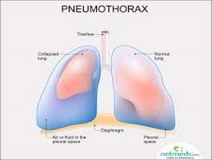 <p>Accumulation of air in the pleural cavity resulting in collapse of the lung</p>