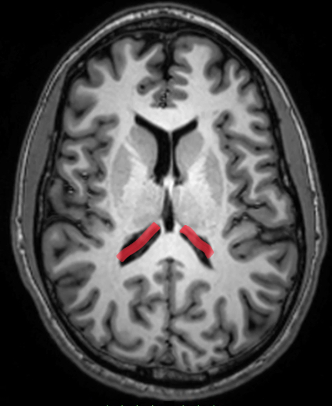 <p>junction between body, occipital, temporal horns</p><p>contains choroid plexus (glomus)—large amount</p>