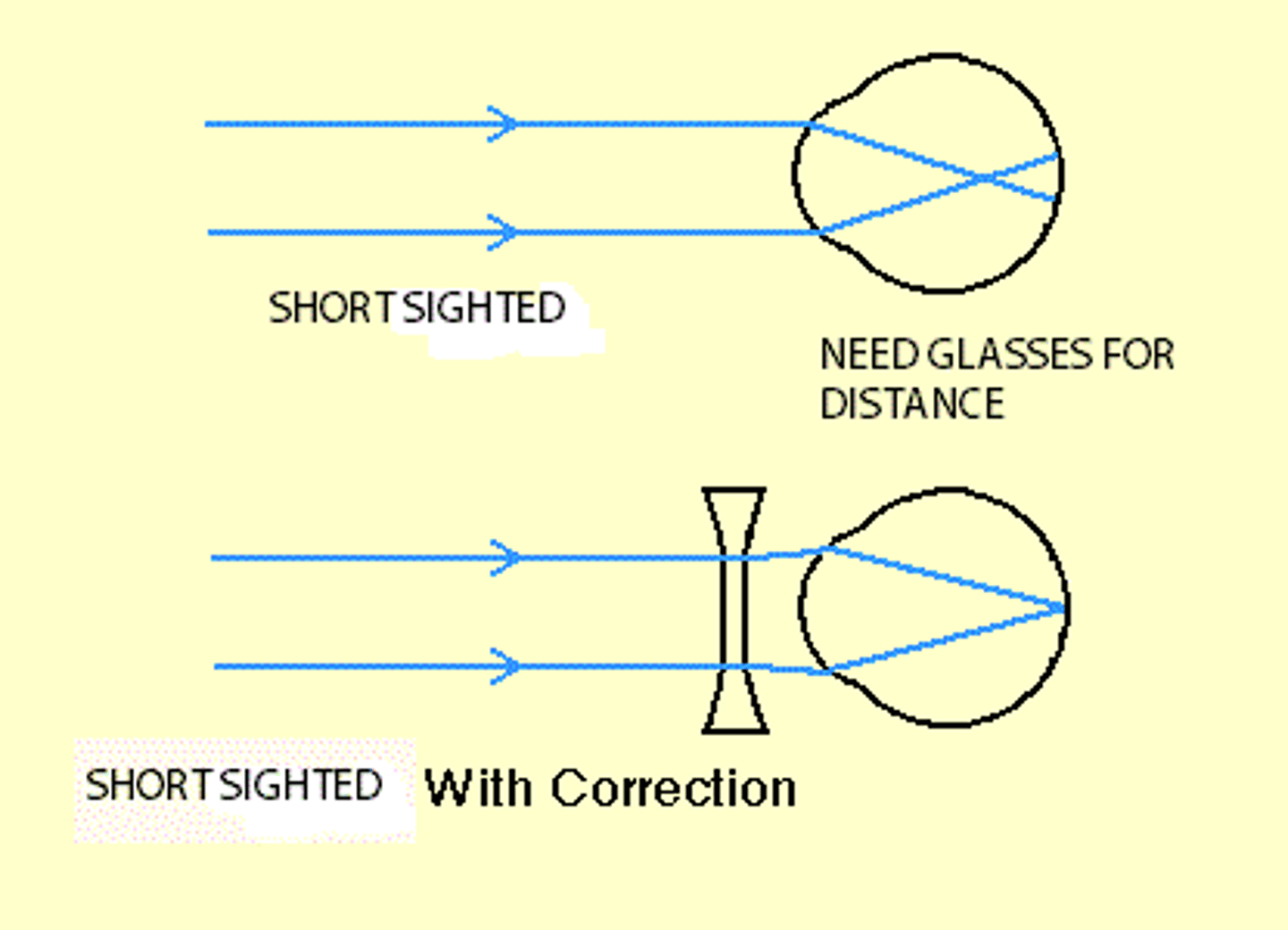 <p>-Unable to focus on distant objects</p><p>-Eyeball too elongated</p><p>-Lens refracts light too much</p><p>-Concave Lenses are used</p>