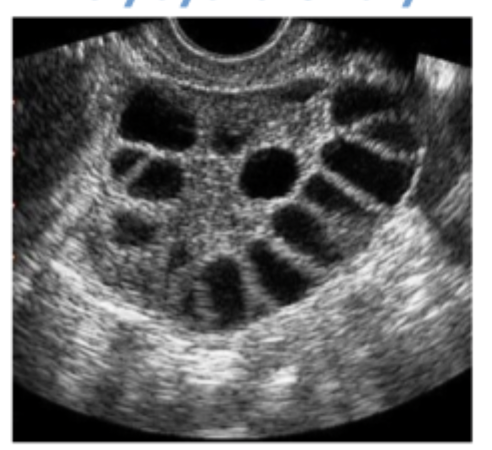 <p>To diagnose PCOS, what do you need to see on U/S - not necessary if menstrual cycle irregularities and hyperandrogenism are present</p>