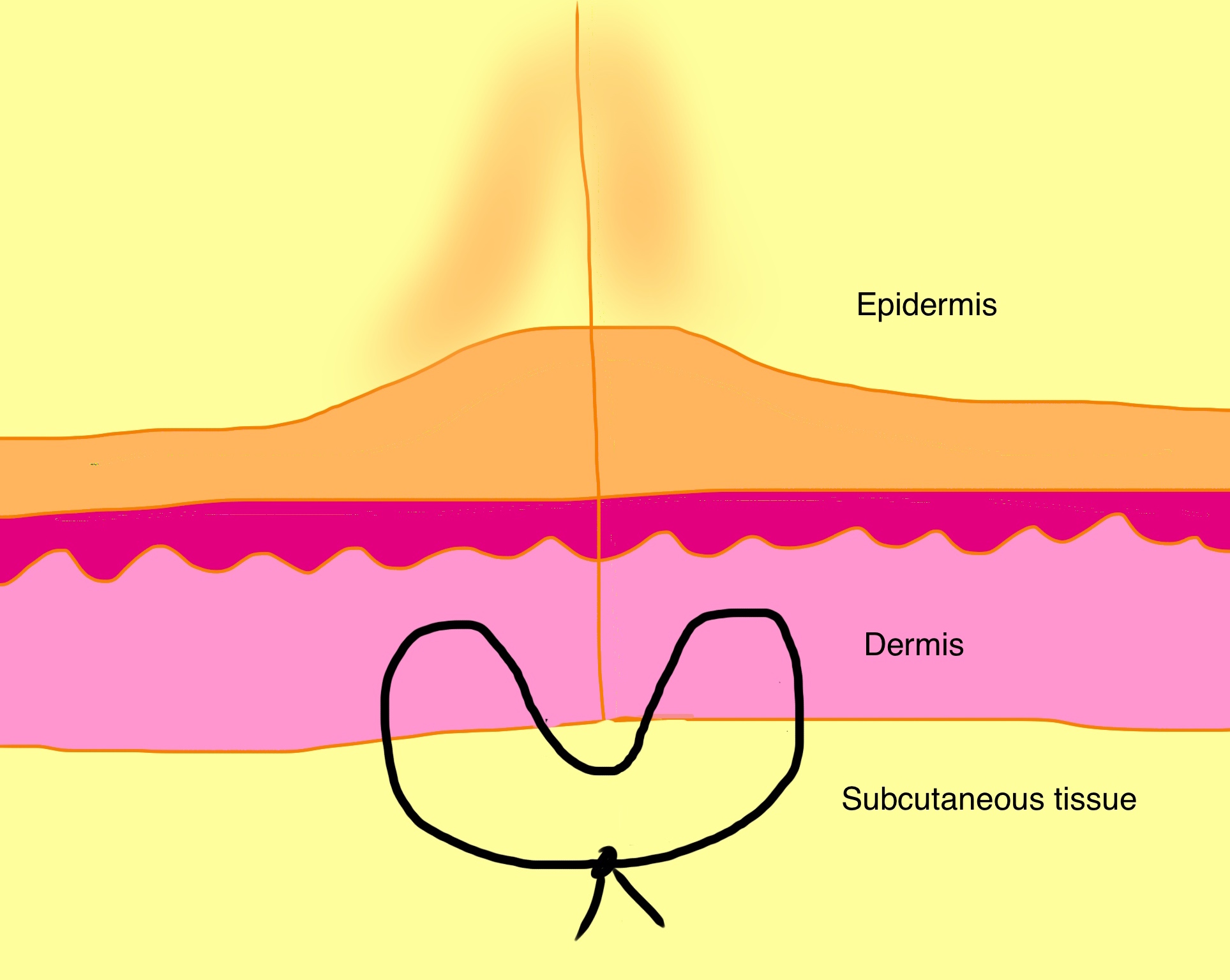 <p>Type of suture</p>