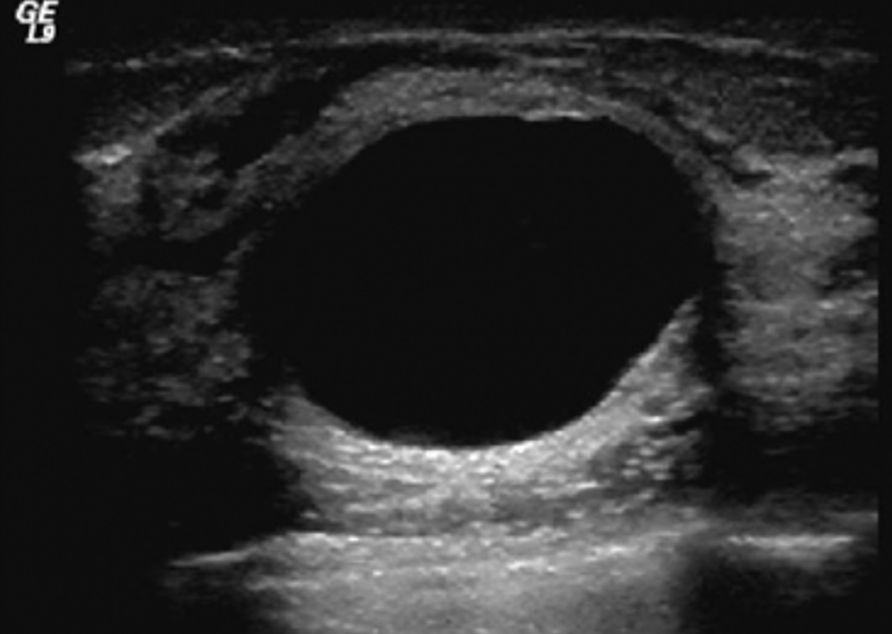 <p>hyperechoic</p>