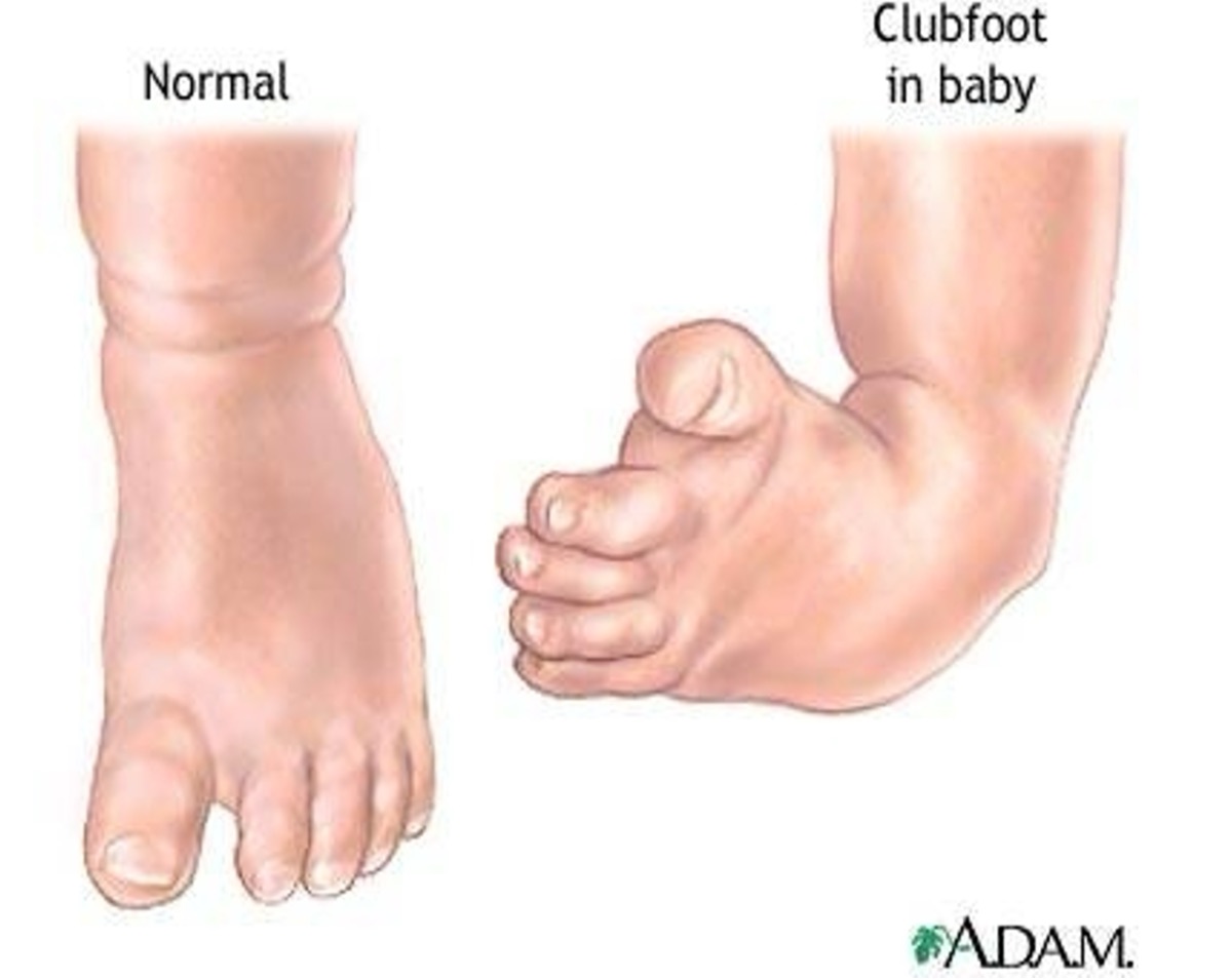<ul><li><p><span><span>congenital abnormality where foot is twisted out of normal position</span></span></p></li><li><p><span><span>can be unknown cause or occur isolated in association with other disorders</span></span></p></li><li><p><span><span>can be unilateral or bilateral</span></span></p></li></ul><p></p>