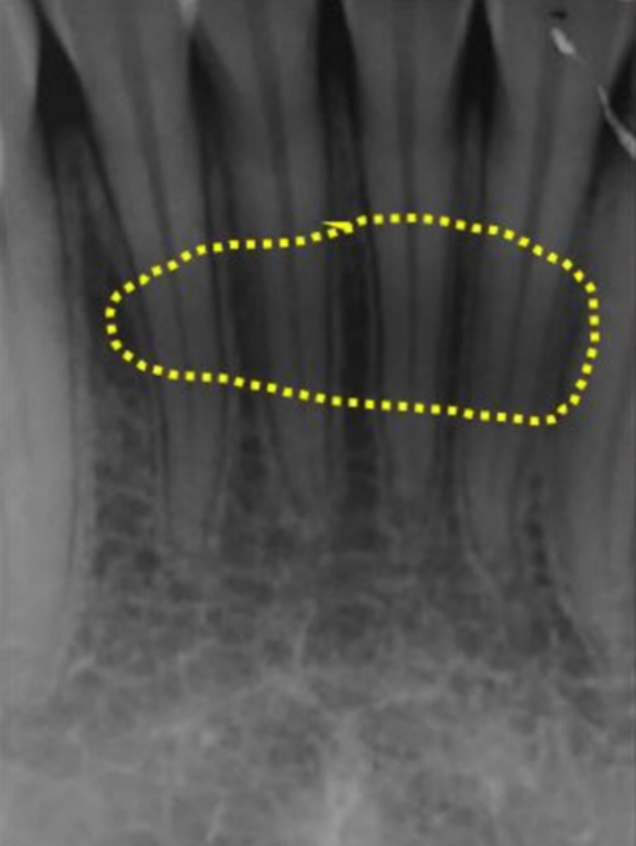 <p>What is the radiolucent oval indicated?</p>