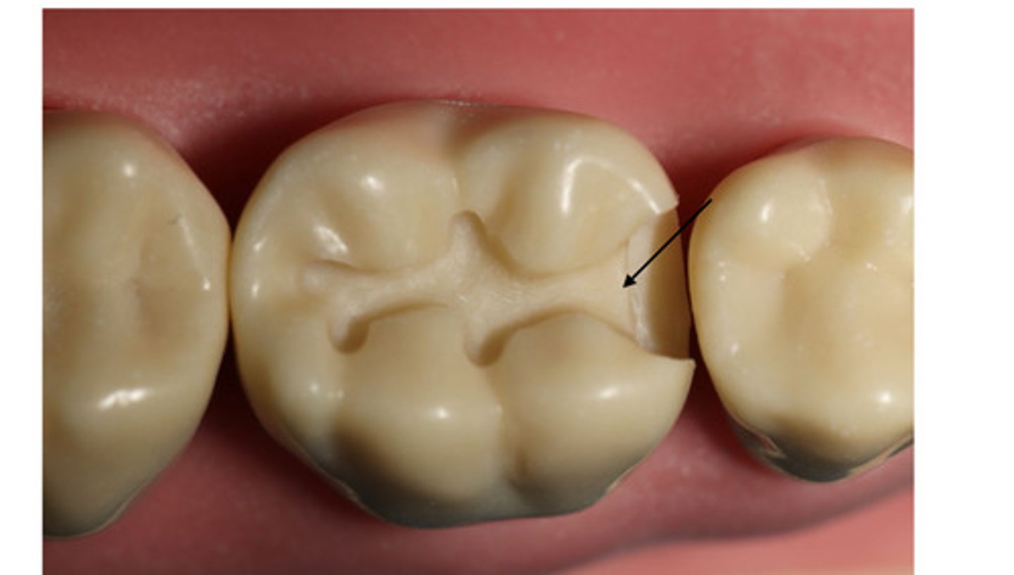 <p>Axiopulpal bevel using a hatchet or a #330 bur at axio- pulpal line angle, not more than __ wide</p>