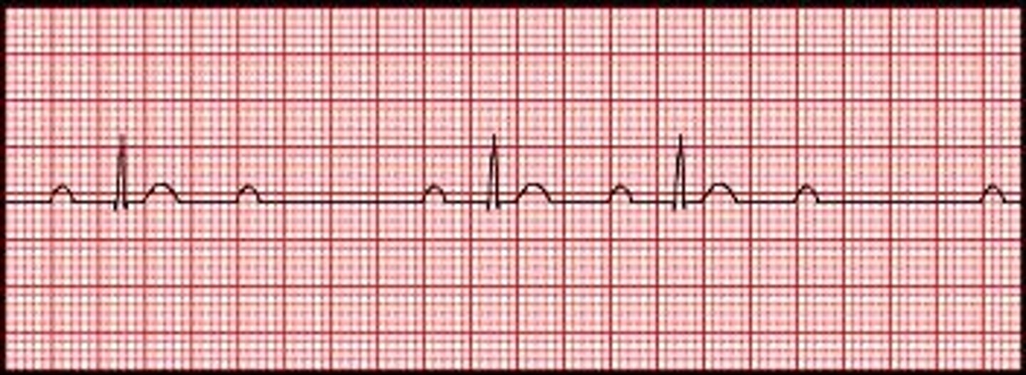 <p>only some of the atrial impulses are conducted through AV node into the ventricles</p><p>PR interval: consistent until a QRS is dropped</p><p>P waves not followed by a QRS</p>