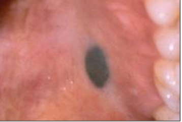 <p>macular/dome shaped blue/black lesion smaller than 1cm</p>
