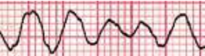 <p>Which cardiac rhythm is shown?</p>