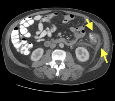 <p><em>CT Abdomen/Pelvis IV contrast</em></p>
