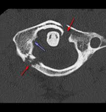 <p>communited fracture of c1. most do not survive this fracture.</p>