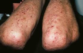 <p>What lesion shape/configuration is this? What condition can cause this?</p>