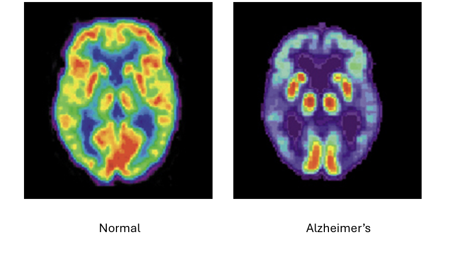 <p>Pt given radioactive tracer —&gt; emittion detected </p><ul><li><p>radiopharm <strong><u>accumulates</u></strong> in target organ based on metabolic activity —&gt;<u>decays</u> and emits gamma radiation —→ <strong><u>increased uptake in areas with increased metabolic activity</u></strong></p></li></ul><p>Key concept: </p><p>Clinical (How is it working): Onco(PET/CT), cardio(SPECT), endo, skeletal, neuro(PET)</p><p>Limits: High rad dose, low spacial resolution, exp</p><p>***”Hot spots” on imaging indicative of infection,, fracture, or malignancy </p><p></p>