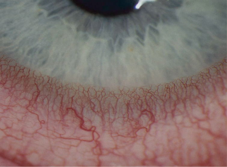 <ul><li><p>blood vessel growth onto cornea at limbus</p></li><li><p><span>Sign of chronic ocular irritation or hypoxia</span></p></li></ul><p></p>