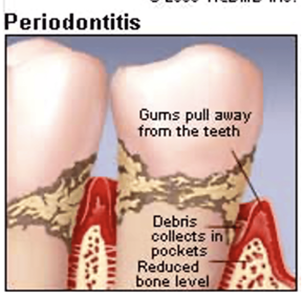 <p><strong>Later phase</strong> – <span class="bgB">periodontitis</span></p><p></p><p>Gingiva inflamed, discolored, bleeds</p><p>•Vague pain in jaws</p><p>--Reduced bone level</p><p>•Pressure – pus expressed</p><p>•Support tissues destroyed</p><p>--Teeth fall out</p>