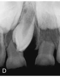<ul><li><p>term for a supernumerary tooth located between the maxillary central incisors</p></li></ul><p></p>