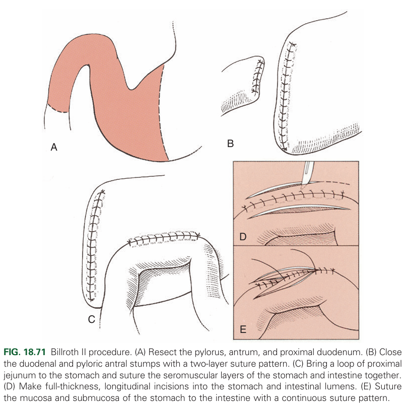 Removal of the pylorus and duodenum and attachment of the jejunum to the stomach.