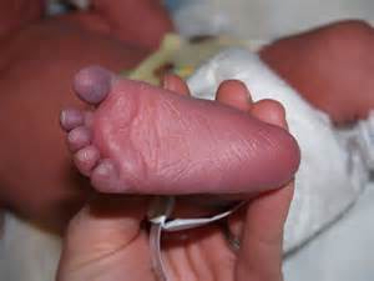 <p>bluish skin color due to lack of oxygen</p>