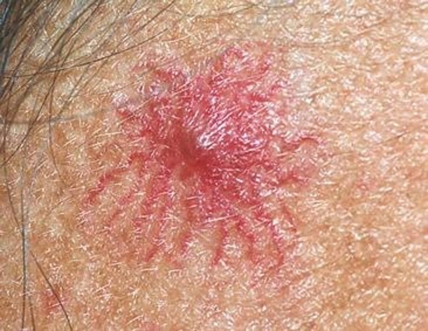 <p>central red macule with radiating spider like arms</p>