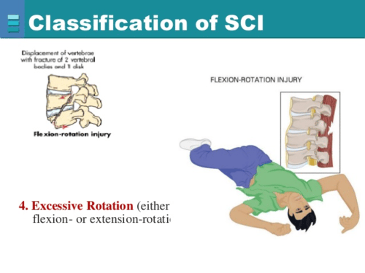 <p>- The spine is bent backward + rotated/twisted beyond normal ROM</p><p>- ligamentous structures that stabilize spine are torn</p>