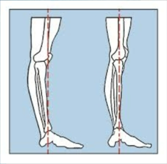 <p>extension continued past the anatomical position</p>