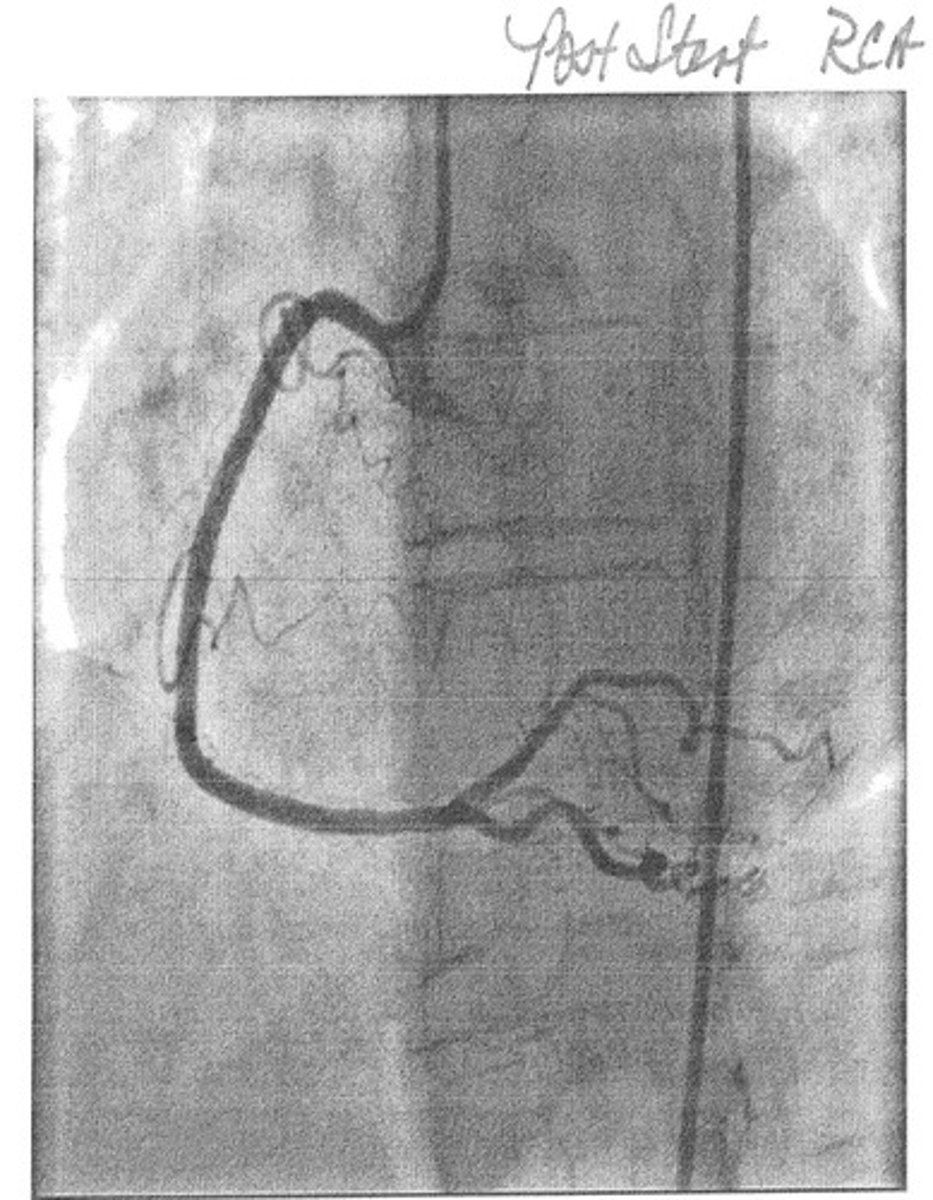 <p>Results from plaques in the arteries.</p>